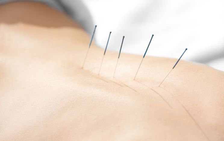 Akupunktur nedir? Akupunktur Uygulamaları, Akupunktur Nerede Kullanılır?