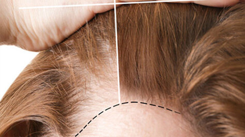 Kadınlar İçin Saç Ekimi