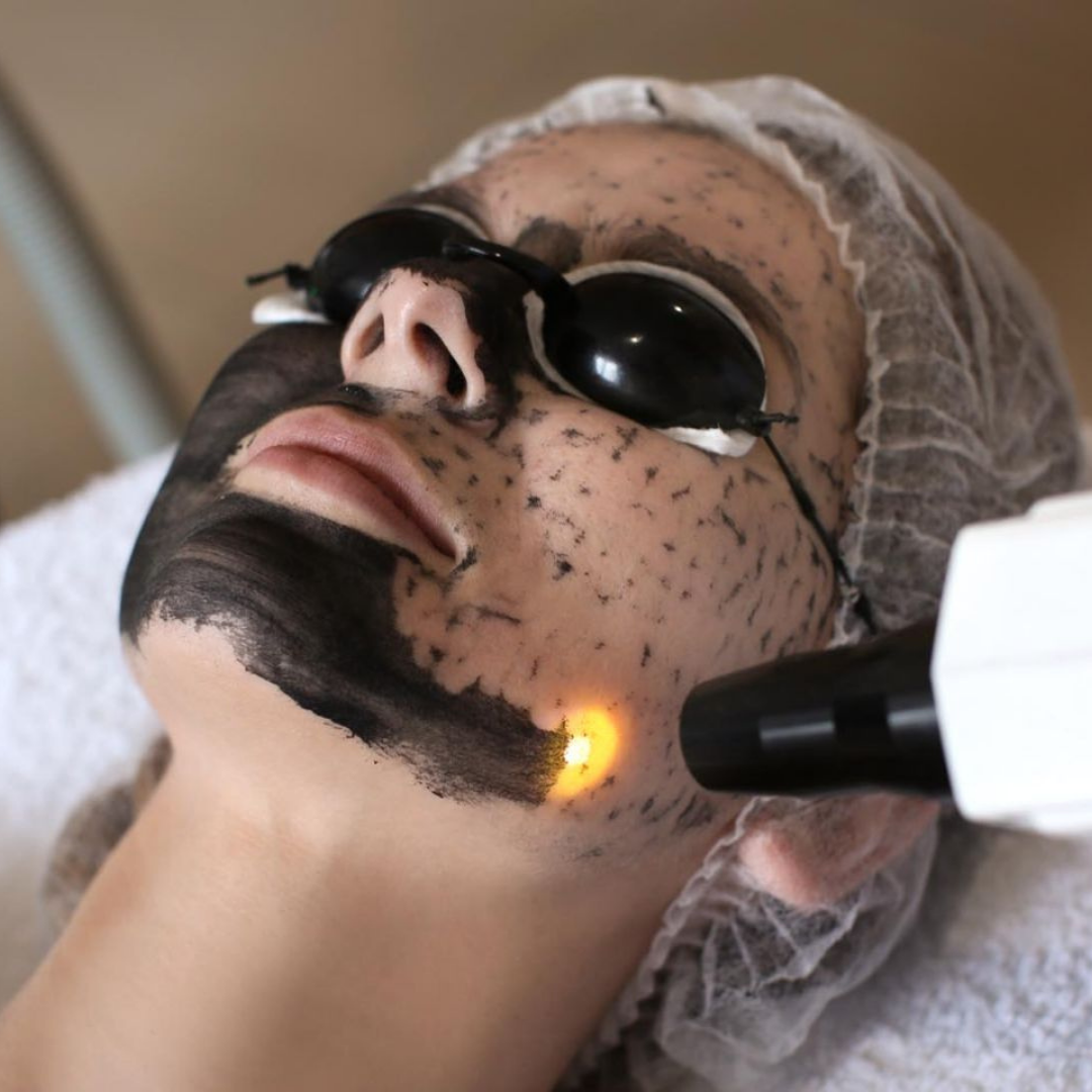 Carbon Peeling